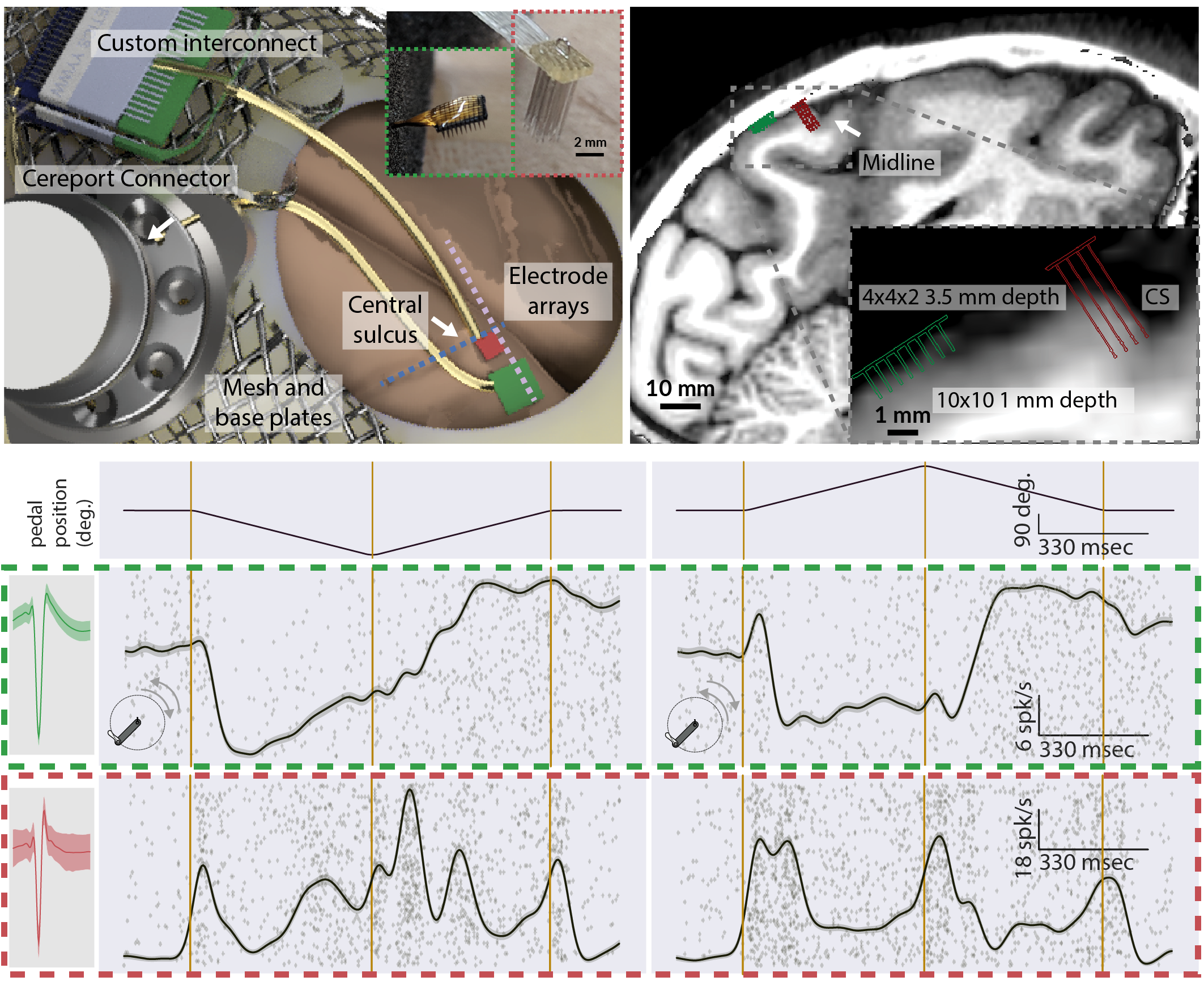 3D mockup and surgical photograph of custom fixation hardware to support intracortical recording devices