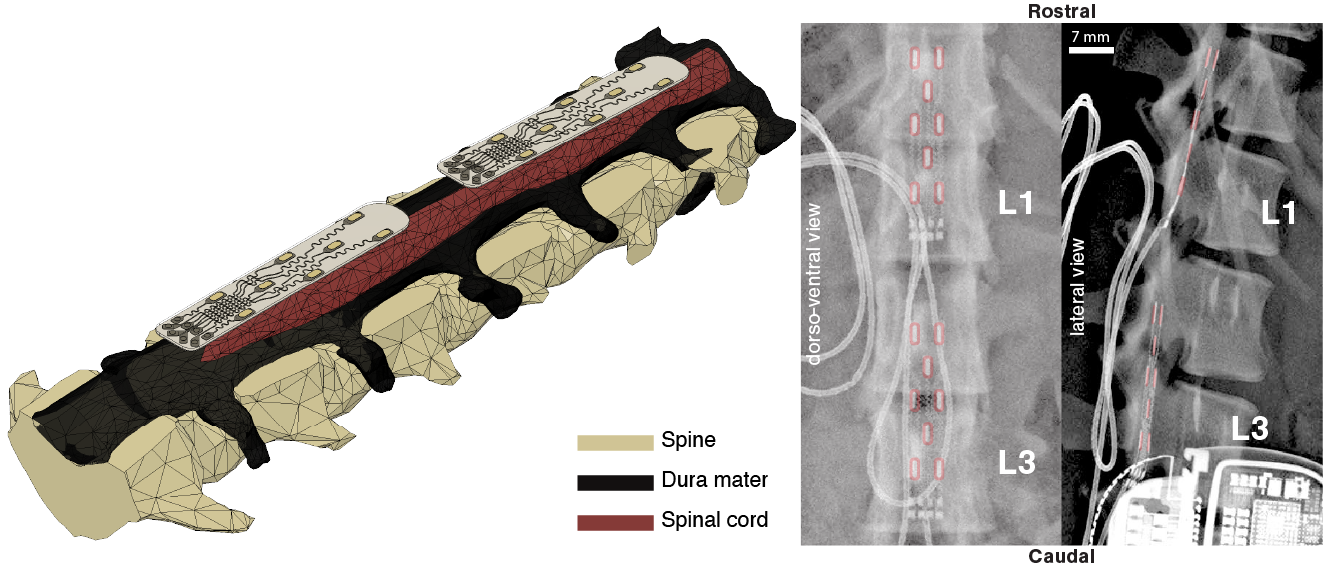 Epidural spinal implant